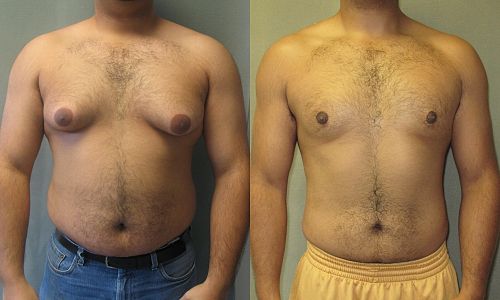 500px GynecomastiaFrontalAsymSevere