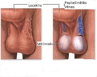 Varikocele