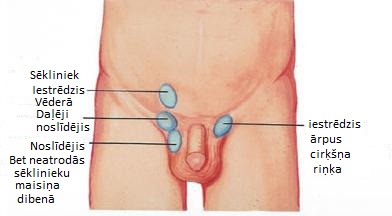 cryptorchidism