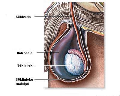 Hidrocēle